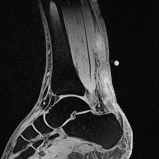 File:Bilateral Achilles tendon complete tear (Radiopaedia 81344-95051 Sagittal WE - Left 55).jpg
