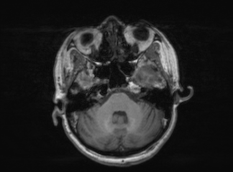 File:Bilateral PCA territory infarction - different ages (Radiopaedia 46200-51784 Axial T1 303).jpg
