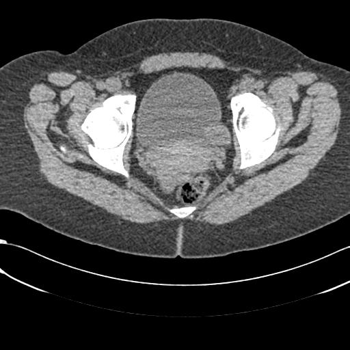 Bilateral acetabular protrusion with pincer type femoro-acetabular impingement (Radiopaedia 30134-30733 AXIAL SOFT THIN 39).jpg