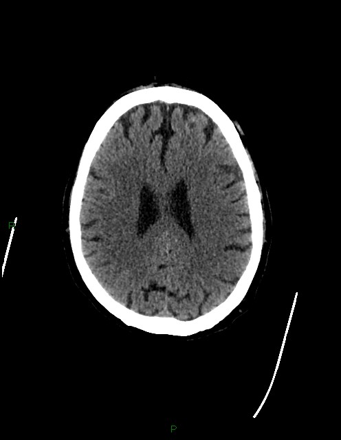 Bilateral acute middle cerebral artery territory infarcts (Radiopaedia 77319-89401 Axial non-contrast 58).jpg
