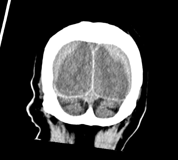 Bilateral acute on chronic subdural hematomas (Radiopaedia 78466-91146 Coronal non-contrast 60).jpg