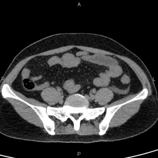 Bilateral adrenal gland hyperenhancement in pancreatitis (Radiopaedia 86642-102753 Axial non-contrast 82).jpg