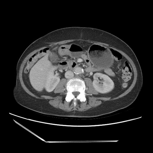 Bilateral adrenal granulocytic sarcomas (chloromas) (Radiopaedia 78375-91007 A 60).jpg