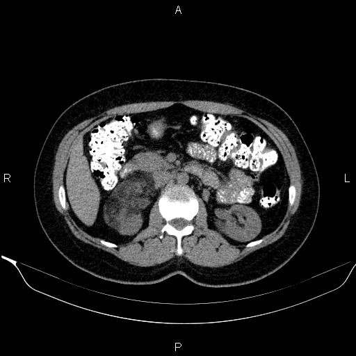 Bilateral adrenal myelolipoma (Radiopaedia 63058-71535 Axial non-contrast 68).jpg