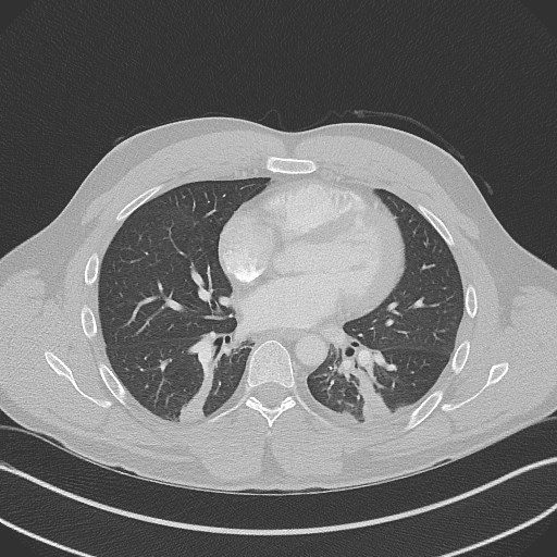 Bilateral atelectasis (Radiopaedia 48666-53675 Axial lung window 65).jpg