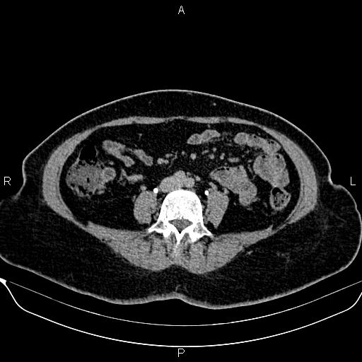 File:Bilateral benign adrenal adenomas (Radiopaedia 86912-103124 Axial C+ delayed 94).jpg