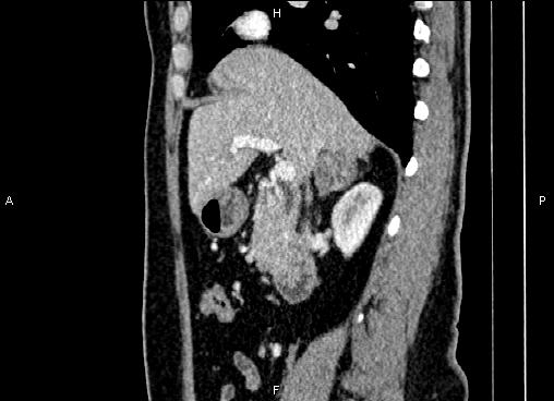 Bilateral benign adrenal adenomas (Radiopaedia 86912-103124 E 38).jpg