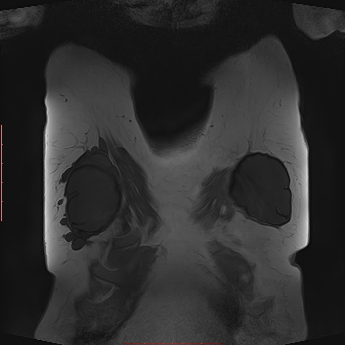 Bilateral breast implant rupture (Radiopaedia 24761-25027 G 51).jpg