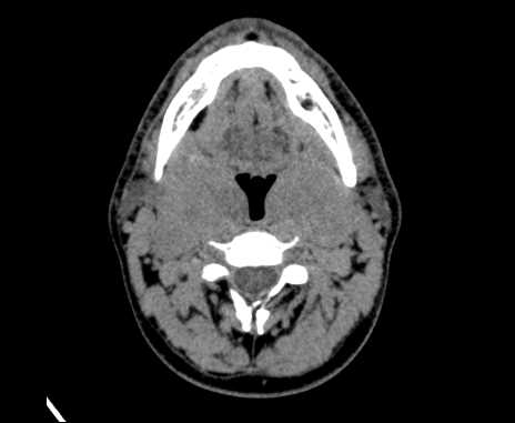 File:Bilateral carotid body tumors (Radiopaedia 61841-69870 Axial non-contrast 42).jpg