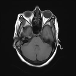 File:Bilateral carotid body tumors and right jugular paraganglioma (Radiopaedia 20024-20060 Axial 27).jpg