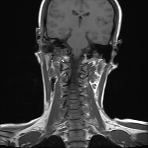 File:Bilateral carotid body tumors and right jugular paraganglioma (Radiopaedia 20024-20060 Coronal 16).jpg