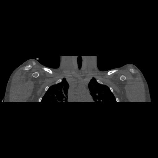 Bilateral chronic posterior shoulder dislocation (Radiopaedia 39213-41452 Coronal bone window 16).jpg