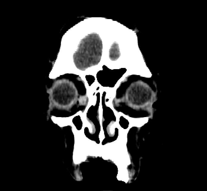 Bilateral ectopia lentis (Radiopaedia 89889-107013 Coronal non-contrast 18).jpg