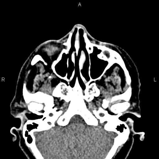 Bilateral enlargement of lacrimal glands - sarcoidosis (Radiopaedia 62627-70921 Axial non-contrast 22).jpg