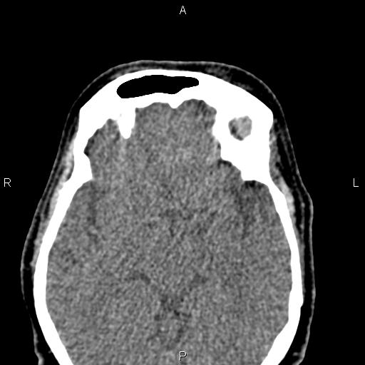 Bilateral enlargement of lacrimal glands - sarcoidosis (Radiopaedia 62627-70921 Axial non-contrast 67).jpg