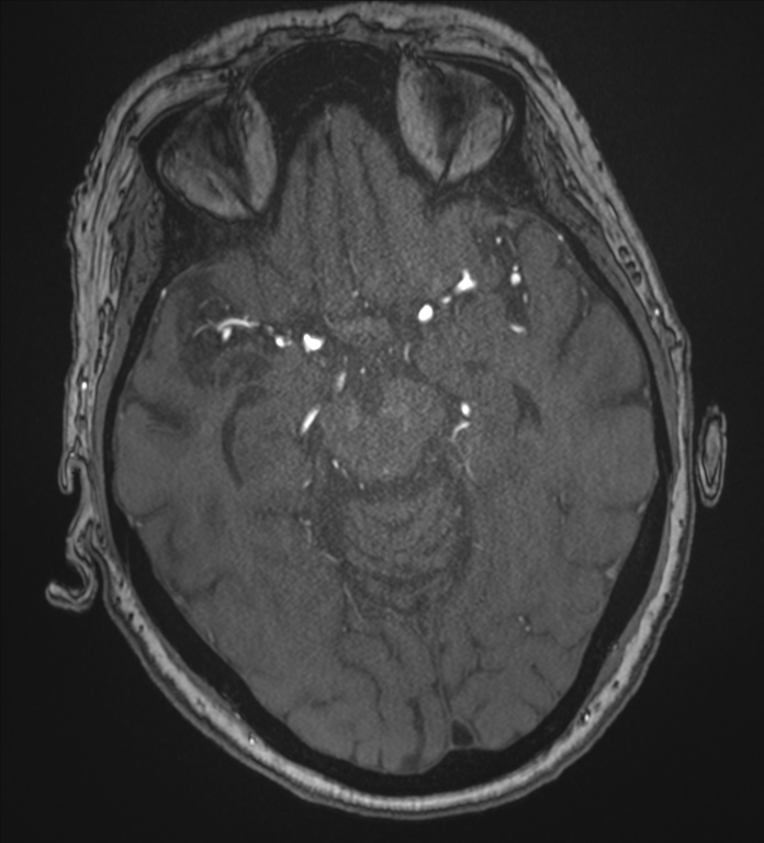 Bilateral fetal posterior communicating arteries (Radiopaedia 41286-44102 Axial MRA 82).png