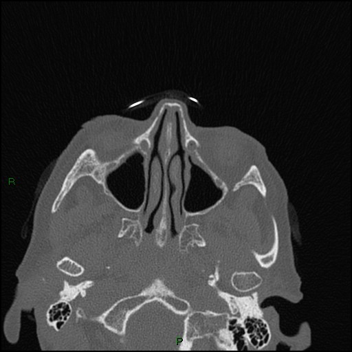 Bilateral frontal mucoceles (Radiopaedia 82352-96454 Axial bone window 178).jpg