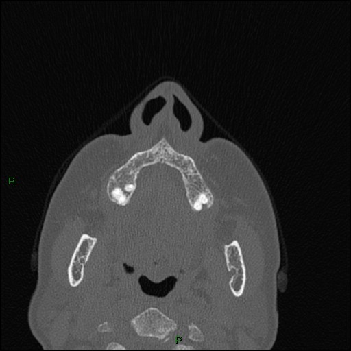 Bilateral frontal mucoceles (Radiopaedia 82352-96454 Axial bone window 246).jpg