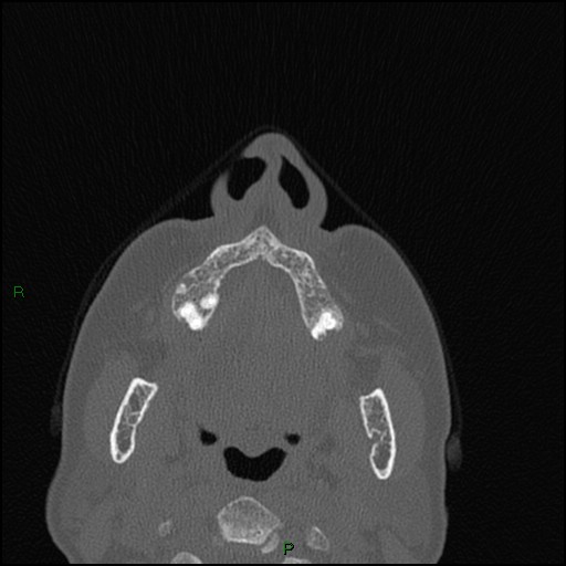 Bilateral frontal mucoceles (Radiopaedia 82352-96454 Axial bone window 248).jpg