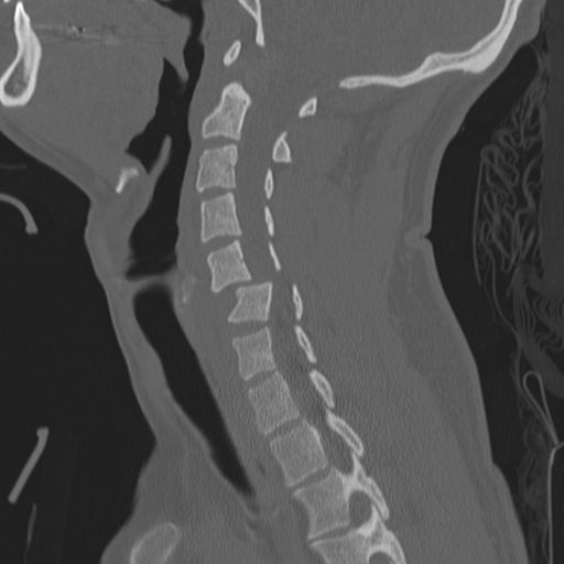 File:Bilateral locked facets (Radiopaedia 33850-35016 Sagittal bone window 18).png
