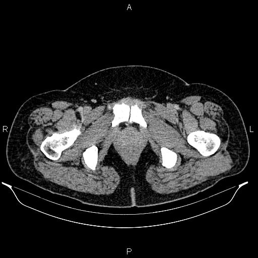 Bilateral ovarian dermoid cysts (Radiopaedia 85785-101603 A 111).jpg