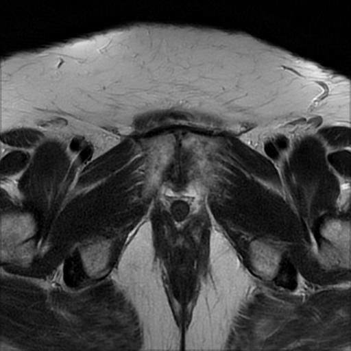 File:Bilateral ovarian dermoid cysts (Radiopaedia 90152-107338 Axial T2 21).jpg