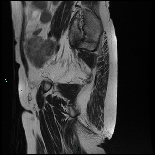 File:Bilateral ovarian fibroma (Radiopaedia 44568-48293 Sagittal T2 7).jpg
