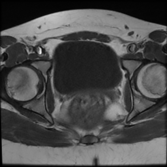 File:Bilateral ovarian fibrothecomas - adolescent (Radiopaedia 86604-102707 Axial T1 23).jpg