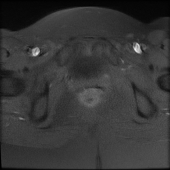 File:Bilateral ovarian fibrothecomas - adolescent (Radiopaedia 86604-102707 Axial T1 fat sat 26).jpg