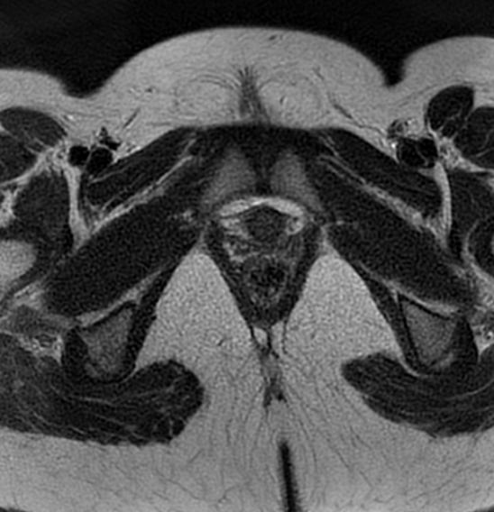 File:Bilateral ovarian fibrothecomas - adolescent (Radiopaedia 86604-102707 Axial T2 44).jpg