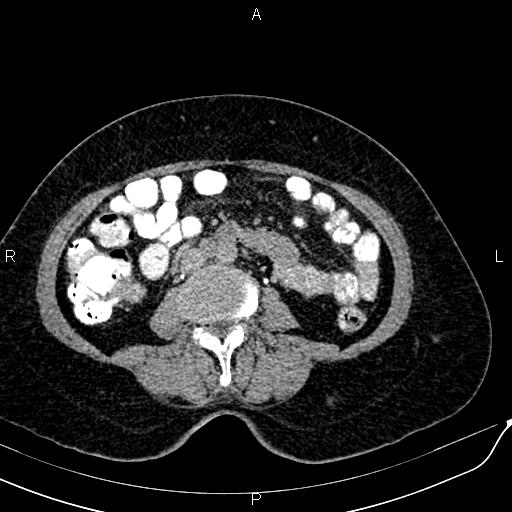 Bilateral ovarian serous cystadenocarcinoma (Radiopaedia 86062-101989 Axial C+ delayed 37).jpg