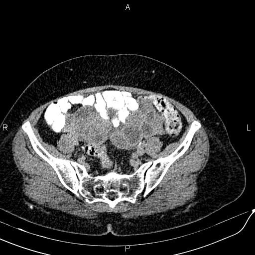 Bilateral ovarian serous cystadenocarcinoma (Radiopaedia 86062-101989 Axial C+ delayed 61).jpg