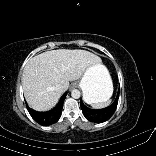 Bilateral ovarian serous cystadenocarcinoma (Radiopaedia 86062-101989 B 17).jpg