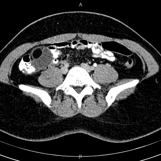Bilateral ovarian teratoma (Radiopaedia 83131-97503 B 7).jpg
