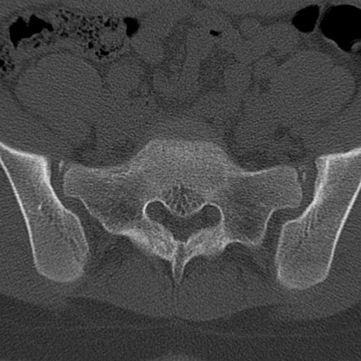 File:Bilateral pars defect (Radiopaedia 26691-26846 Axial bone window 81).jpg