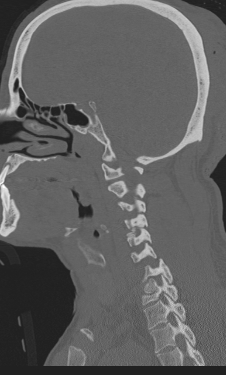 Bilateral perched facet joint (Radiopaedia 63149-71669 Sagittal bone window 13).jpg