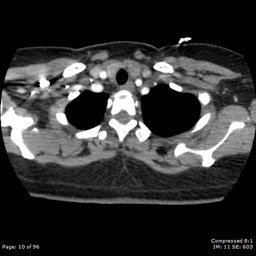 File:Bilateral pulmonary emboli with Hampton hump sign (Radiopaedia 54070-60246 Axial C+ CTPA 7).jpg