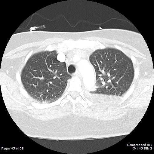 Bilateral pulmonary emboli with Hampton hump sign (Radiopaedia 54070-60246 Axial lung window 45).jpg