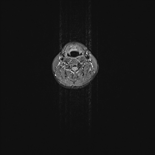 File:Bilateral spinoglenoid notch ganglion cysts (Radiopaedia 29577-30082 Axial STIR 3).jpg