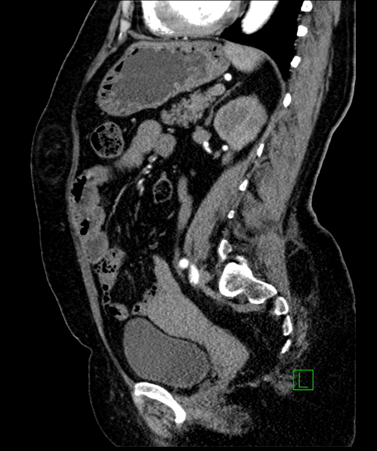 Bilateral sporadic synchronous clear cell renal cell carcinoma (Radiopaedia 85035-100575 E 53).jpg