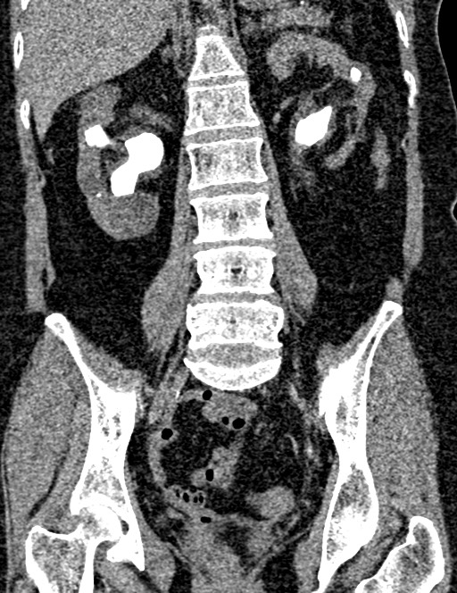 Bilateral staghorn calculi (Radiopaedia 59475-66842 Coronal non-contrast 66).jpg