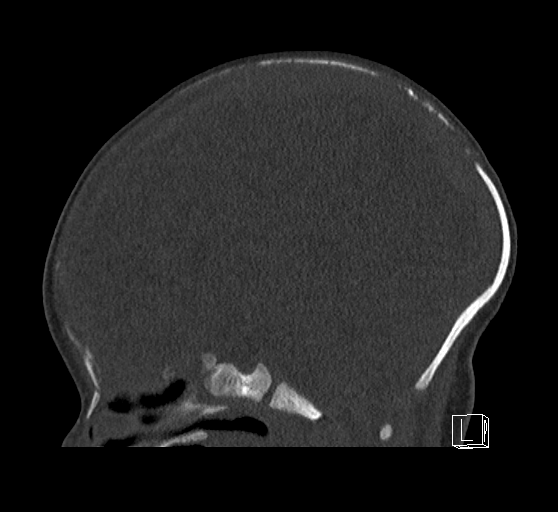 Bilateral subdural hemorrhage and parietal skull fracture (Radiopaedia 26058-26192 Sagittal bone window 51).png