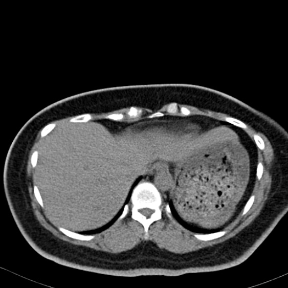 Bilateral ureteric stents (Radiopaedia 48795-53825 Axial non-contrast 3).jpg