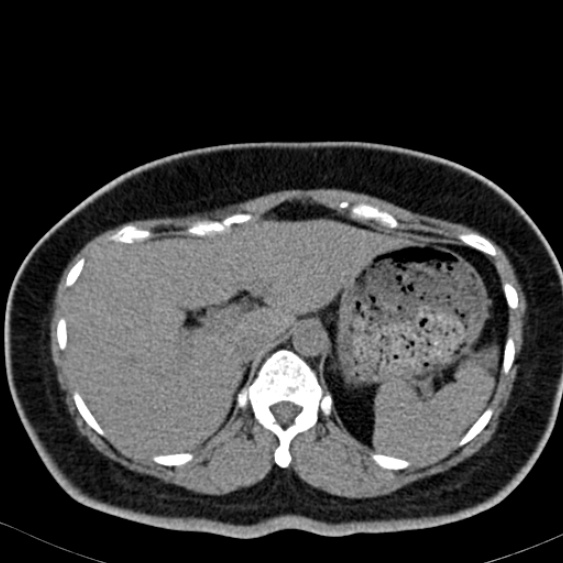 File:Bilateral ureteric stents (Radiopaedia 48795-53825 Axial non-contrast 9).jpg