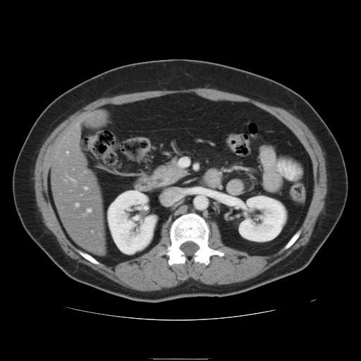 File:Billroth I gastric resection (Radiopaedia 17685-17425 None 14).jpg