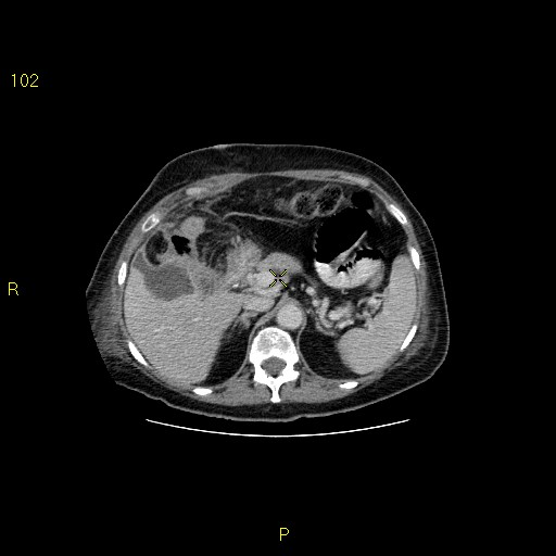 File:Biloma with drainage into the colon (Radiopaedia 20032-20068 A 6).jpg