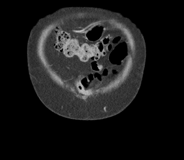 Bladder papillary urothelial carcinoma (Radiopaedia 48119-52951 C 7).png