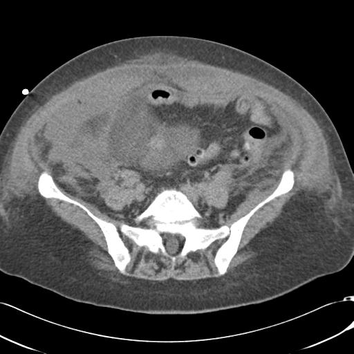 Bladder rupture post renal biopsy (Radiopaedia 30863-31572 Axial non-contrast 60).jpg