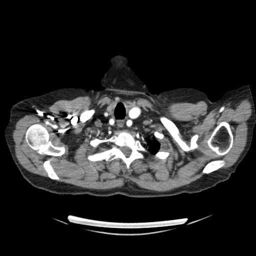 File:Bladder tumor detected on trauma CT (Radiopaedia 51809-57609 A 11).jpg