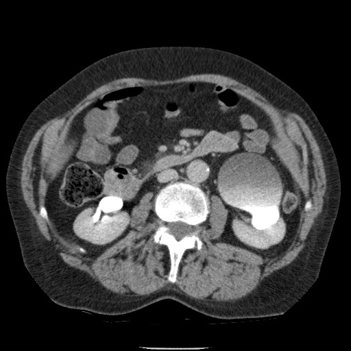 Bladder tumor detected on trauma CT (Radiopaedia 51809-57609 C 63).jpg
